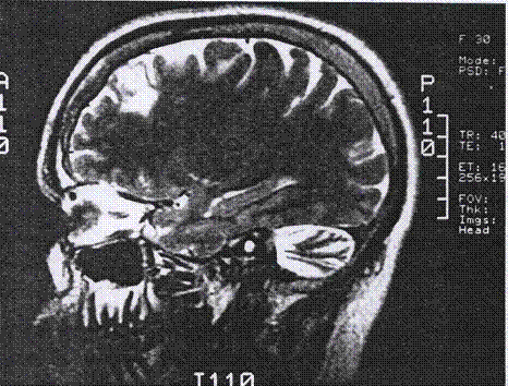 frontal lobe epilepsy